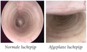 onderzoek-luchpijp-met-endoscoop