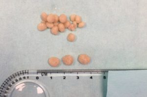 Blaassteentjes die bij een teef zijn verwijderd via urohydropropulsie.